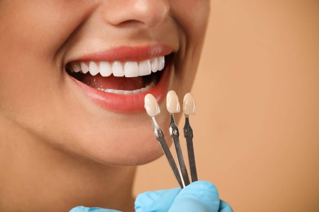 Dental veneers utah