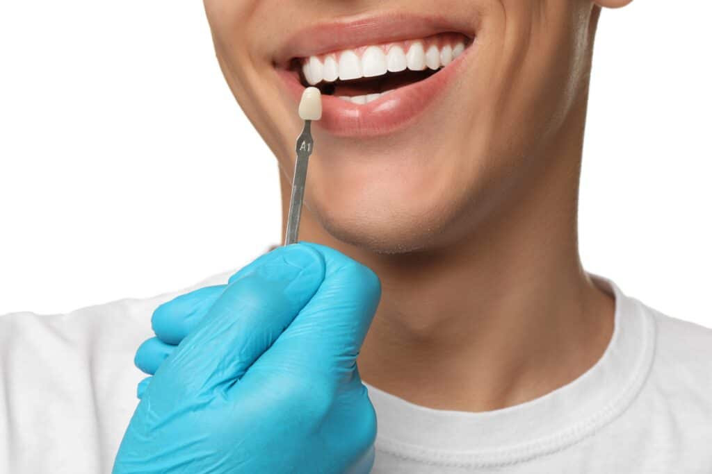 dental veneers ogden